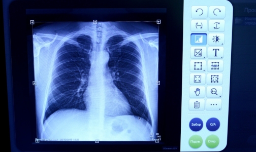 За полгода в Петербурге смертность от болезней органов дыхания выросла почти на 30%