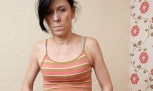 Врачи вернули молодость 16-летней девушке с синдромом «Бенджамина Баттона»