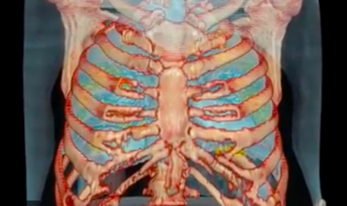 Американские медики показали 3D-видео органов пациента с коронавирусом