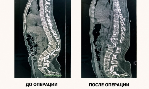 Краснодарские нейрохирурги спасли молодого парня от паралича ног, удалив ему горб